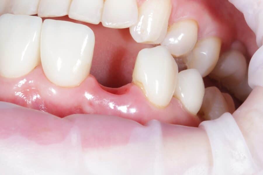 Patient after a tooth extraction in Rapid City, SD